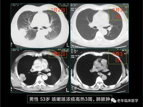 肺部下叶有炎症是怎么回事 肺部下叶有炎症是怎么回事