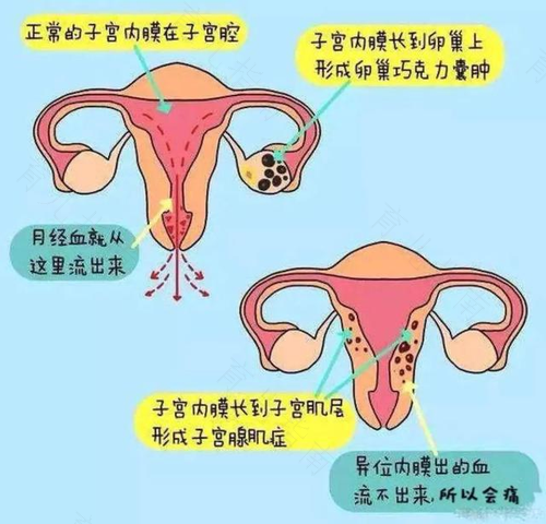 有子宫腺肌症能喝酒吗?