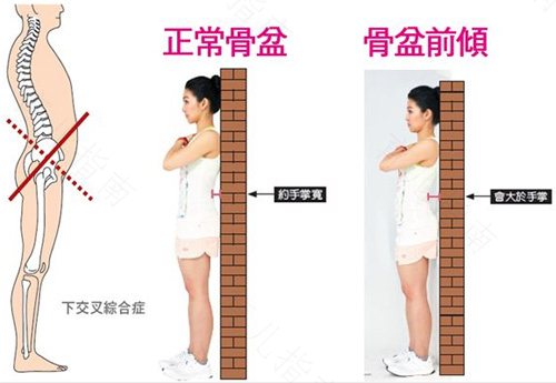 骨盆前倾多久能矫正好 骨盆前倾多久能矫正好