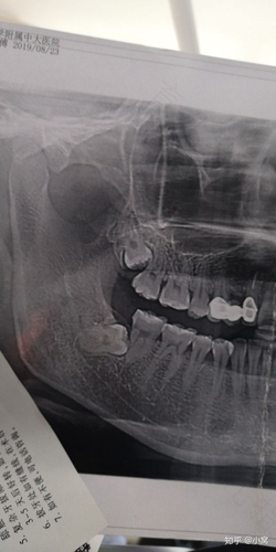 拔上颚智齿需要拍片吗 拔上颚智齿需要拍片吗