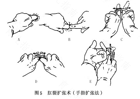 新生儿肛裂怎么办呢 新生儿肛裂怎么办呢
