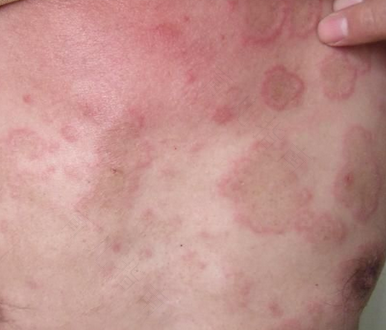 红斑狼疮初期能治愈吗 红斑狼疮初期能治愈吗