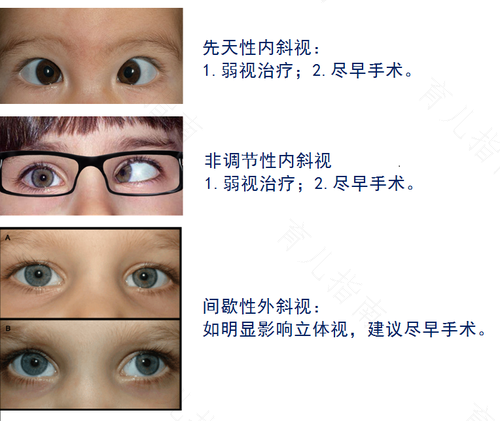 一只眼睛向外斜视怎么办 一只眼睛向外斜视怎么办