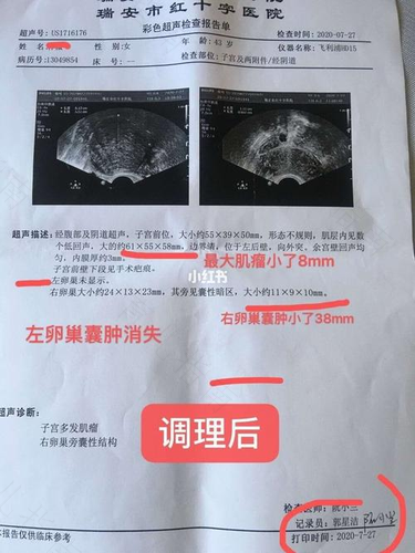 子宫囊肿十厘米怎么办 子宫囊肿十厘米怎么办