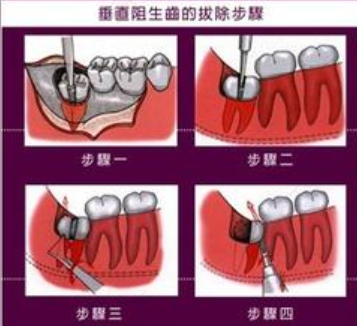 拔大牙后的注意事项