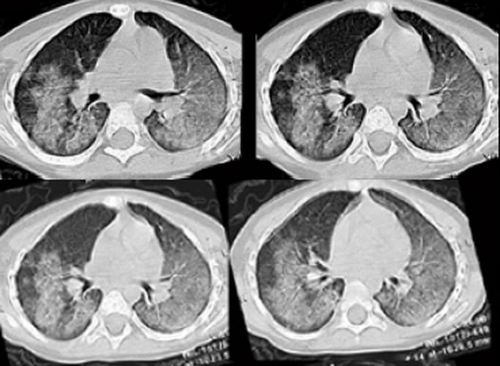 车祸肺出血严重吗能治好吗