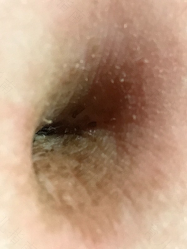 肚脐眼恶臭怎么办 肚脐眼恶臭怎么办