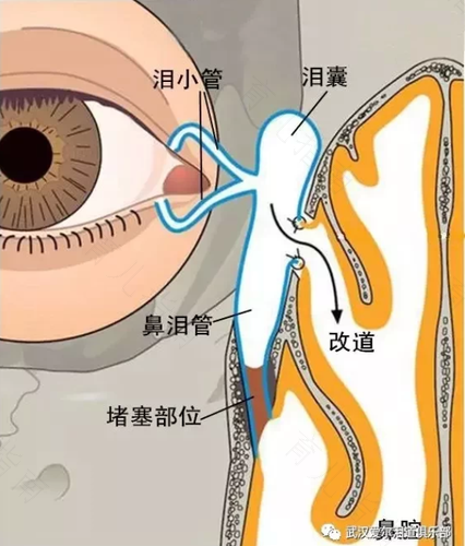 慢性泪囊炎的危害及其处理 慢性泪囊炎的危害及其处理