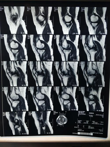 右膝关节积液怎么办 右膝关节积液怎么办