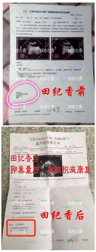 附件囊肿扭转症状 附件囊肿扭转症状