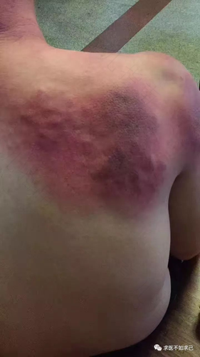 副乳怎么刮痧视频教程 副乳怎么刮痧视频教程