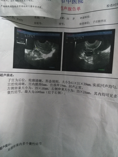 右侧卵巢囊肿会自己消失吗 右侧卵巢囊肿会自己消失吗