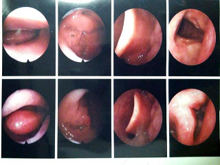 小孩嗓子起泡是怎么回事 小孩嗓子起泡是怎么回事