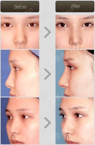 长大鼻子会有变化吗