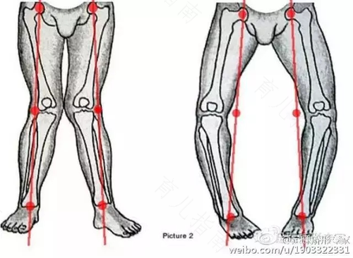 青春期佝偻病能治好吗 青春期佝偻病能治好吗