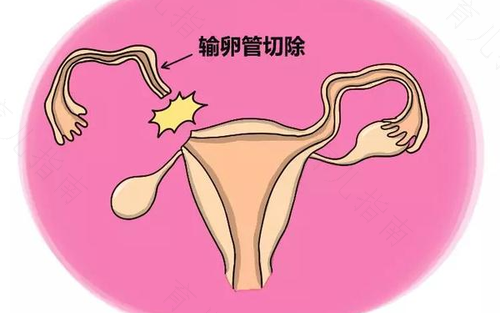 输卵管手术以后注意哪些事项 输卵管手术以后注意哪些事项