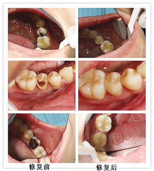 拔了蛀牙之后那个坑怎么办 拔了蛀牙之后那个坑怎么办