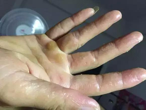手过敏红肿发痒怎么办 手过敏红肿发痒怎么办