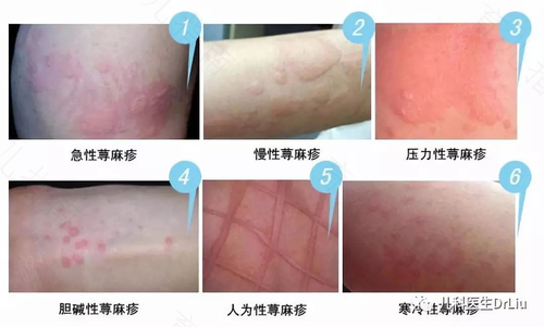 过敏性荨麻疹怎么治疗最快 过敏性荨麻疹怎么治疗最快