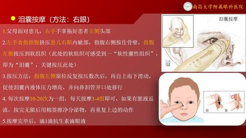 新生儿泪囊炎应早治疗