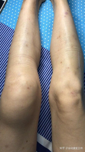 膝盖关节有炎症怎么办 膝盖关节有炎症怎么办