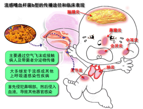 b型流感嗜血杆菌是什么意思 b型流感嗜血杆菌是什么意思