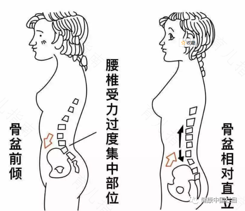 骨盆歪斜怎么矫正图片 骨盆歪斜怎么矫正图片