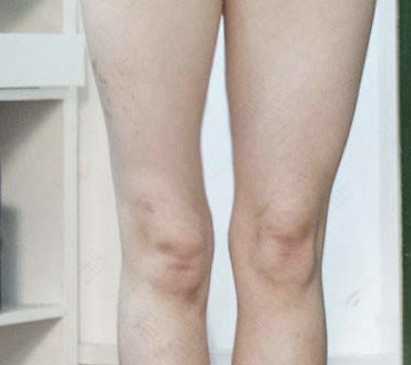 腿部肌肉无力是怎么回事 腿部肌肉无力是怎么回事