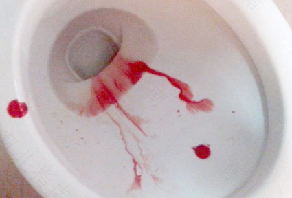 痔疮出血怎么治疗法 痔疮出血怎么治疗法