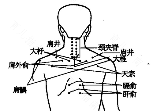 拔罐放血能治三叉神经疼吗 拔罐放血能治三叉神经疼吗