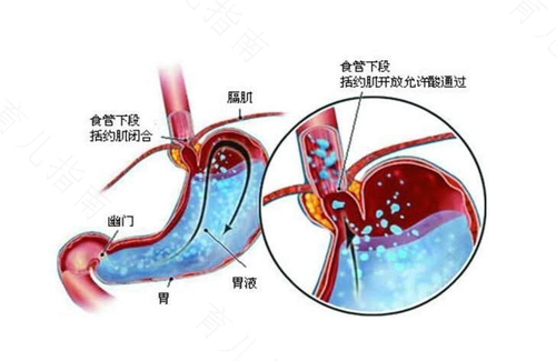 新技能:解决BB胃食道反流的正确姿势 新技能:解决BB胃食道反流的正确姿势