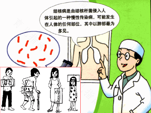 肺结核引起胸痛是怎么回事 肺结核引起胸痛是怎么回事