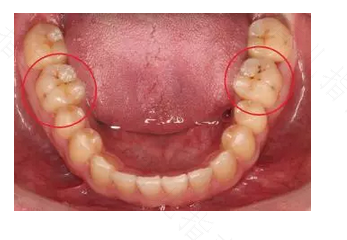 后槽牙牙龈肿痛怎么办?