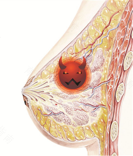 非哺乳期乳腺管堵塞有什么症状 非哺乳期乳腺管堵塞有什么症状