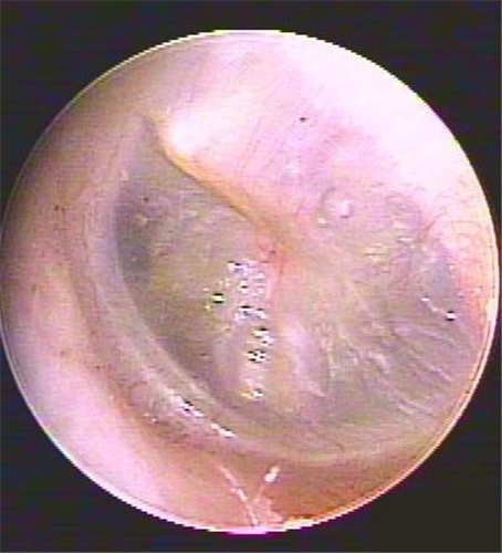 小孩鼓膜内陷怎么办