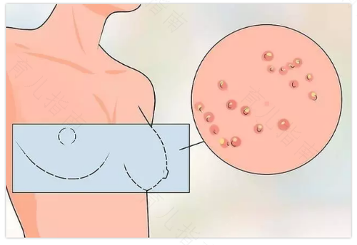乳腺癌最常见的症状就是乳房胀痛