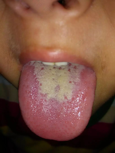 上火舌苔发白厚怎么办 上火舌苔发白厚怎么办