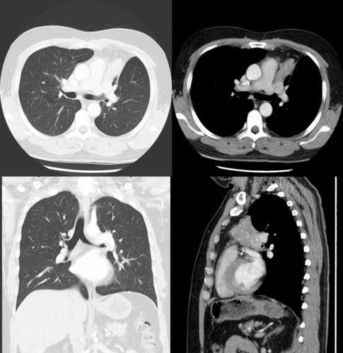 支气管变窄闭塞怎么回事 支气管变窄闭塞怎么回事