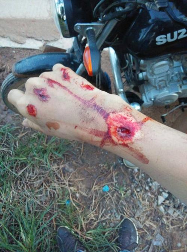 24小时后打破伤风有用吗