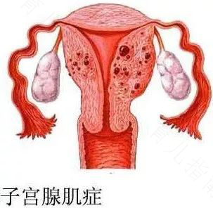 子宫腺肌症子宫全切会有什么后遗症 子宫腺肌症子宫全切会有什么后遗症