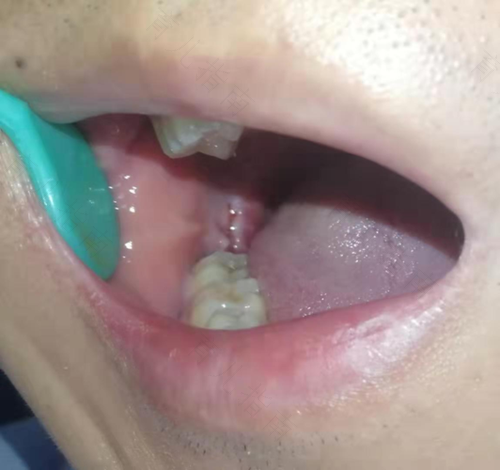 拔牙后七天还疼,正常吗 拔牙后七天还疼,正常吗