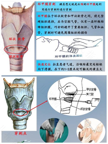 穿刺手术是什么病