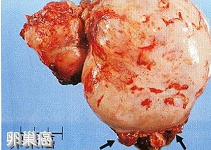 卵巢癌晚期腹水转移能活多久 卵巢癌晚期腹水转移能活多久