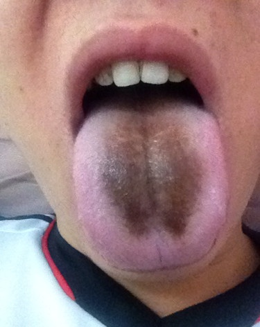 宝宝感冒舌苔发白是什么原因 宝宝感冒舌苔发白是什么原因