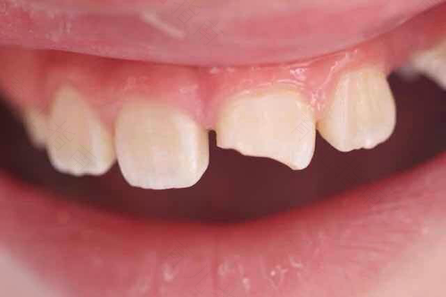 成人门牙磕掉了怎么办 成人门牙磕掉了怎么办