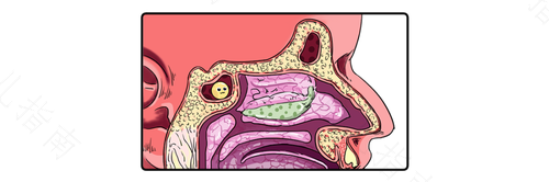 鼻窦炎出血会不会癌变
