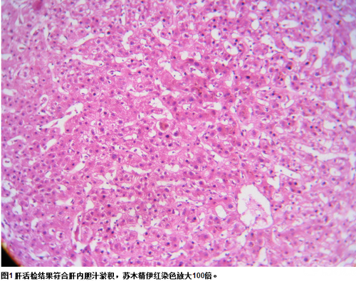 胆汁淤积症有什么症状怎么治疗 胆汁淤积症有什么症状怎么治疗