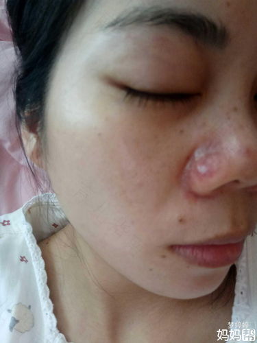 鼻头上火长脓包怎么办鼻子眼 鼻头上火长脓包怎么办鼻子眼