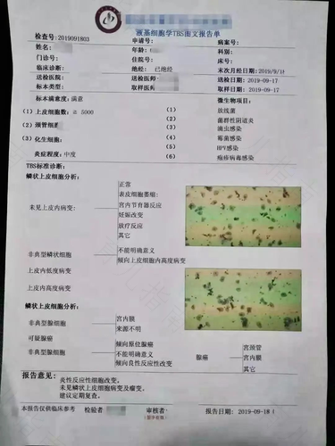 tct检查结果中度炎症严重吗 tct检查结果中度炎症严重吗