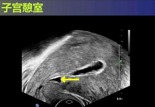 子宫憩室的危害有哪些 子宫憩室的危害有哪些